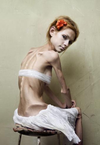 Bulimia Bulimia